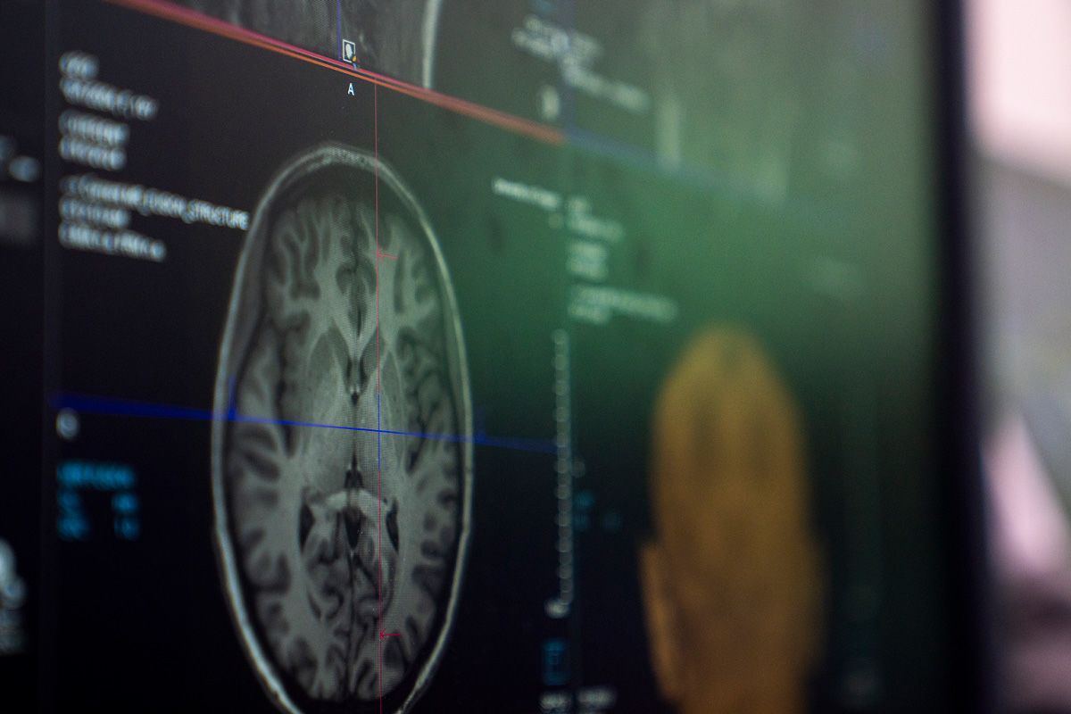 A black-and-white brain scan on a computer screen